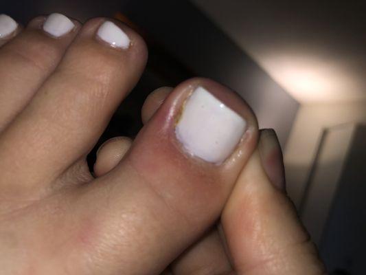 Infected nail the next day