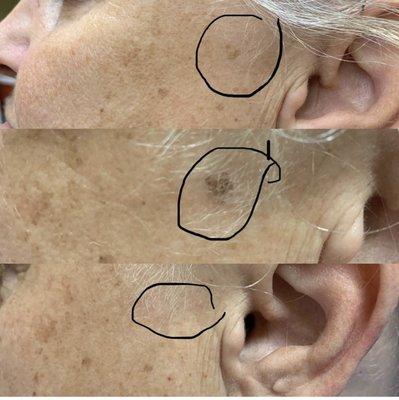 Age spot removal