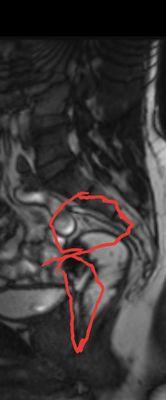 Small intestins wrapped around prolapsed sigmoid colon(enterocele,sigmoidaceleetc)