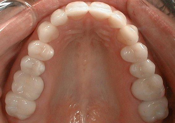 After- Maxillary Occlusal