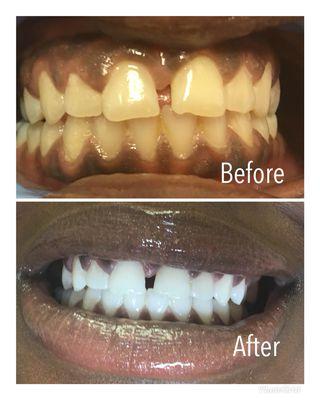 Organic LED Laser Teeth Whitening