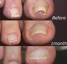 Before and After Ingrown toenail correction/brace. Results time very depending on severity of ingrown toenail.