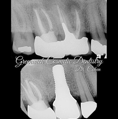 Dental Implant Case