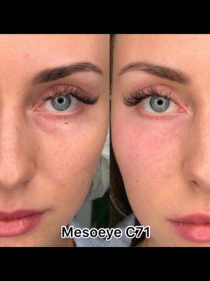 Dark circles and bag reduction around eyes