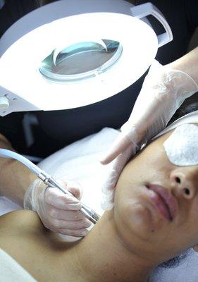 Microdermabrasion