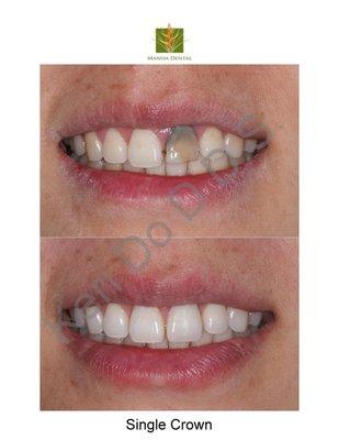 A single cosmetic crown was done on the discolored tooth (a measurement of the skills of cosmetic dentistry)