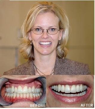 4 veneers