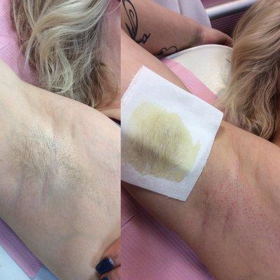 Underarm Waxing helps the hair become finer and less dense