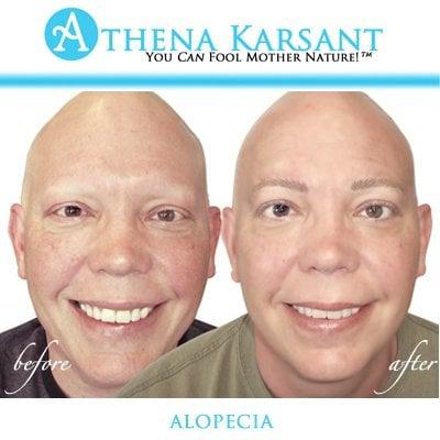 Athena has been able to successfully create eyebrows and simulate individual eyelashes to camouflage the effects of alopecia.