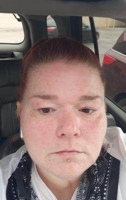 This picture doesn't show how  blotchy I am, after two days out from the Facial I receive on 04/22/2021