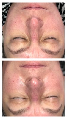 Before & after the signature dermazen facial