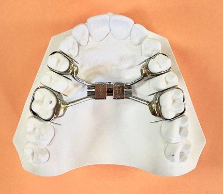 palate expander