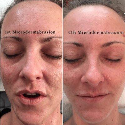 Microdermabrasion