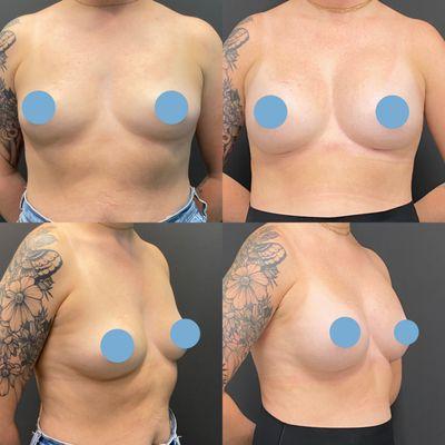 Breast Augmentation before and after:
She received 280CC silicone gel breast implants, low plus profile placed under the muscle!