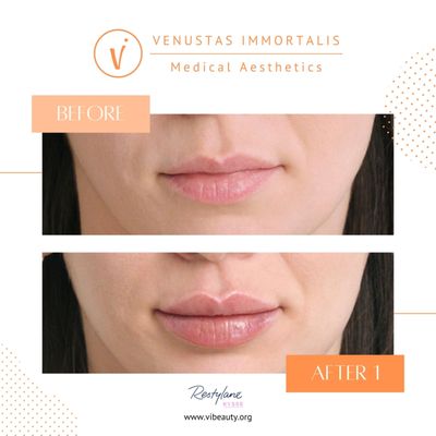 Lip Filler - Med Spa in Janesville, WI