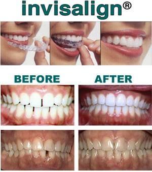 *Invisalign Orthodontic Treatment - before & after