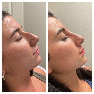 Liquid Nose Job. "Liquid Rhinoplasty."