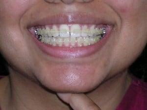 6 month braces with clear wire