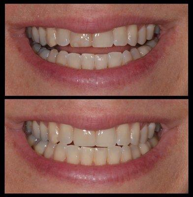 Single porcelain veneer on tooth #8. Difficult color match. My patient was very pleased with her new smile!