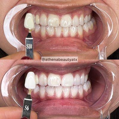 Advanced Teeth Whitening, 4 shades whiter in 60 minutes!