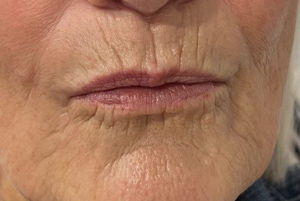 Smokers lines are difficult to treat but we can use dermal filler to soften the lines