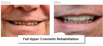 Full upper cosmetic rehabilitation