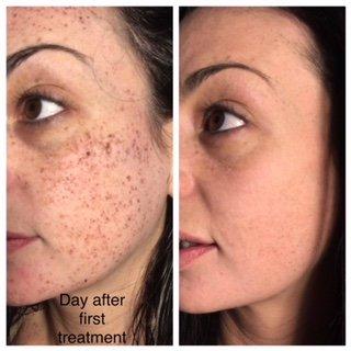 Amazing results after only 1 treatment for sun spot and freckle removal!