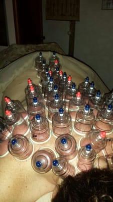 Cupping session