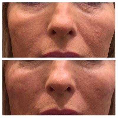 Before and after: the top picture shows shadows from mid-face volume loss which dramatically improved with dermal fillers