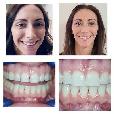 As Lisa puts it, "My smile is flawwlesss!" Call today for a free Invisalign consultation! $3,797 or $102/month for a limited time!