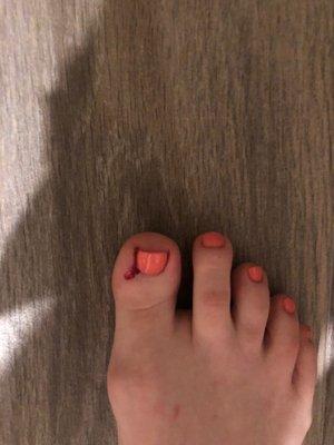 Bloody toe