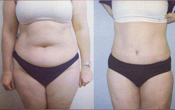 Body Contouring and Liposuction