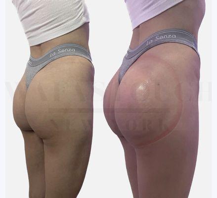 Service: Non-Surgical Booty Lift  Amazing results our client got in 1 SESSION! Contacts us to book your appointment today