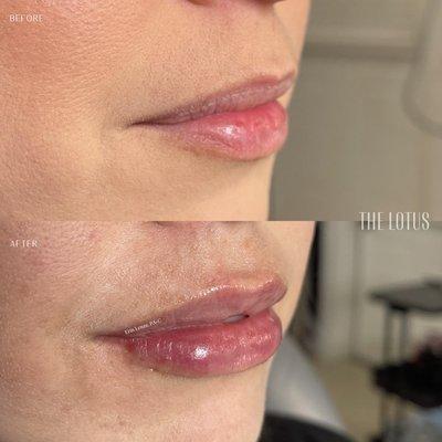 Lip Augmentation by Erin Lenza, PA-C