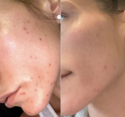 1 month progress via Glymed Acne Skincare Home Regimen 
 
 https://www.instagram.com/thefloridafacialist/