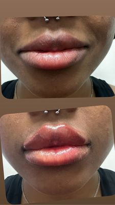 Lip enhancement