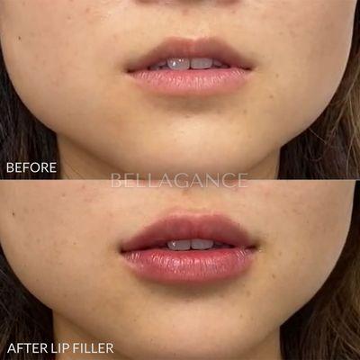 Lip filler treatment by PA Tancora.