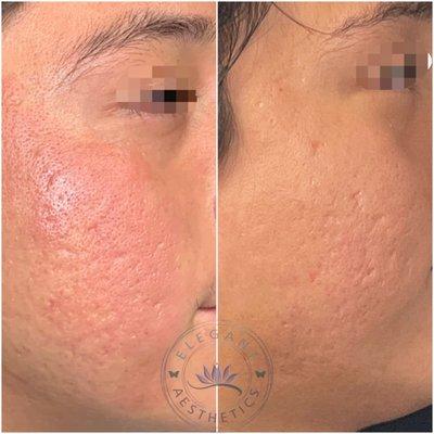 Microneedling