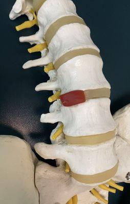 Lumbar Disc Herniation Model