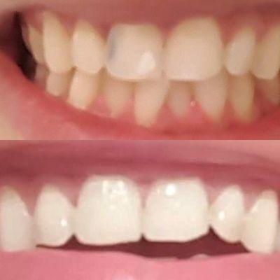 Before and after with composite veneer