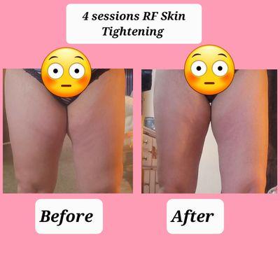 Radio Frequency- skin tightening & cellulite reduction