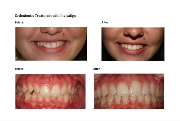 Before and after Invisalign case