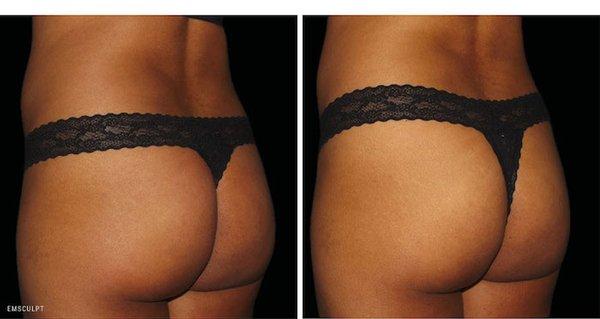 Emsculpt to lift and tone the buttocks