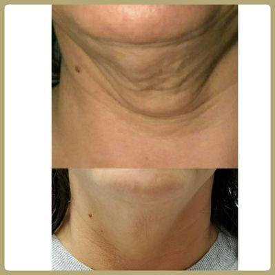 Sagging neck
Before/after