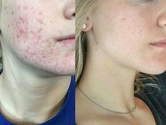 Before & after photo of 18-year-old client using our acne homecare products and following our protocol.