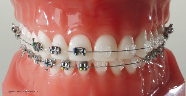 Metal and Clear braces