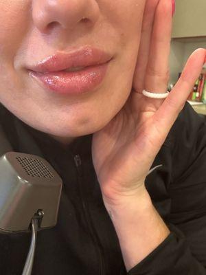 After with Juvederm Volbella lip filler