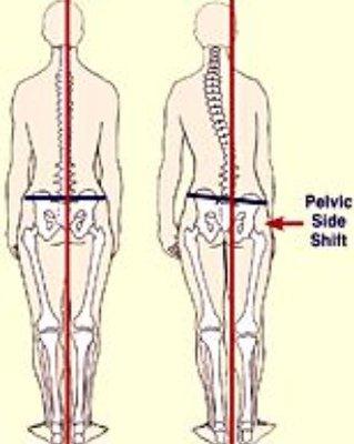 Tight muscles pull spine out of alignment...GET FIXED