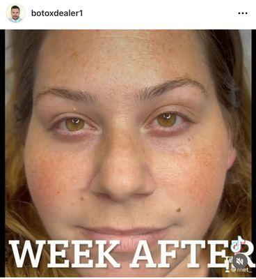 Botox 1 week after