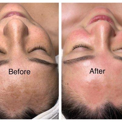 Before and after pictures of the dermaplane with hydrafacial treatment.